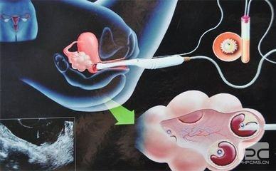 私人志愿者供卵助孕包生儿子